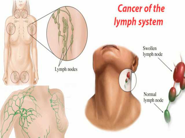 लिम्फोमा कैंसर  - लक्षण, उपचार और कारण